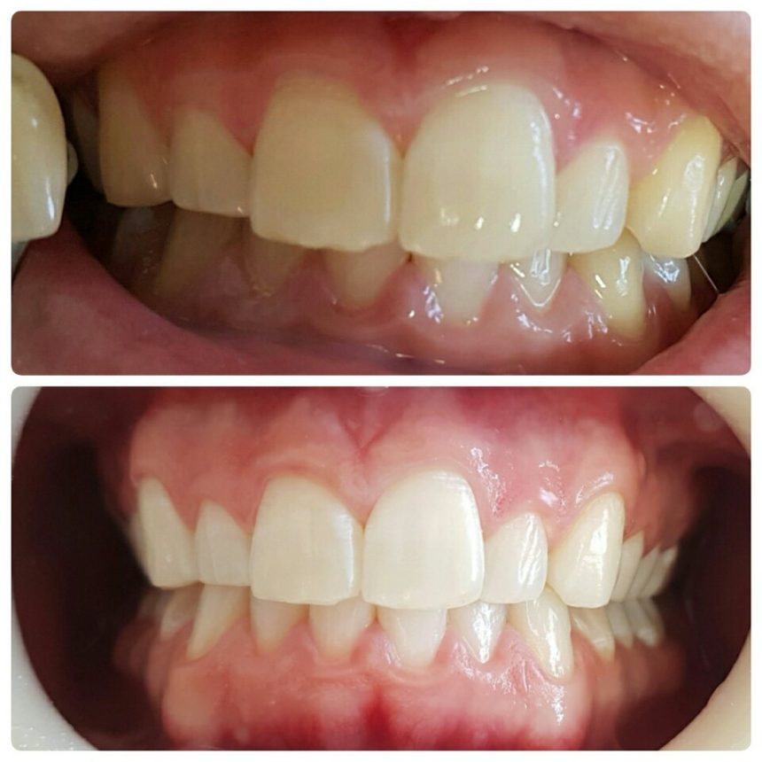 Exemplo de clareamento dental a laser